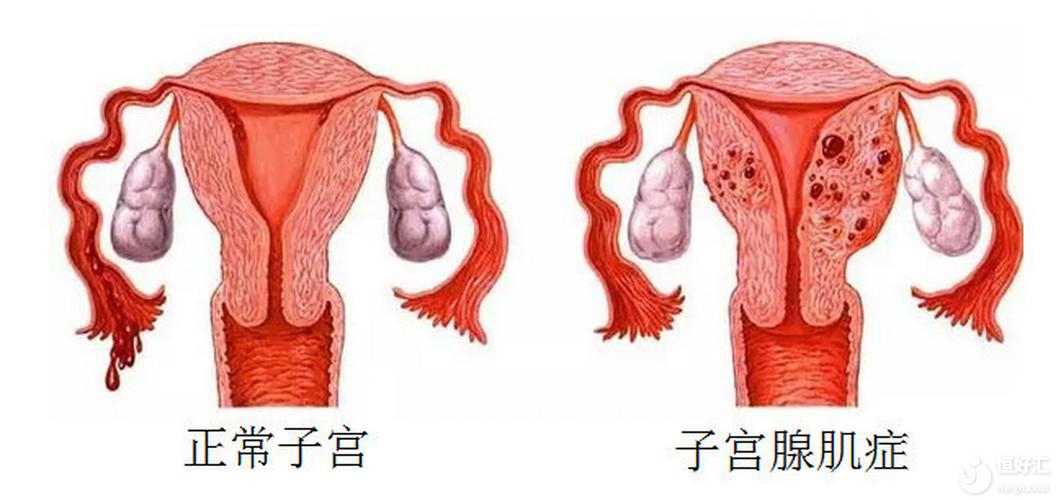 腺肌症对怀孕的影响，你不会还不知道吧?